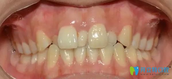 武漢清華陽光口腔金屬托槽矯正牙齒前