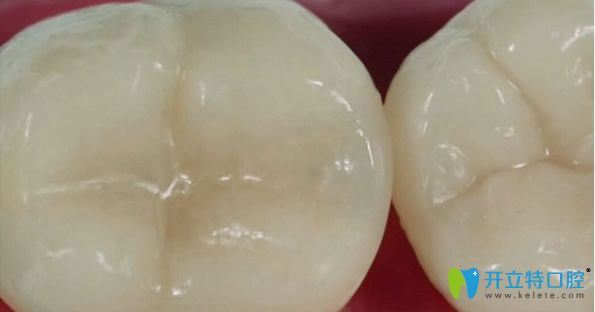 傳統(tǒng)補(bǔ)牙后牙齒壽命不長(zhǎng)