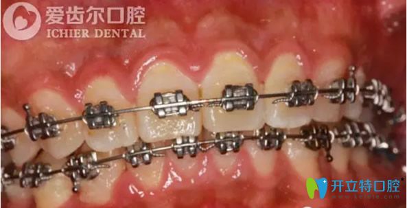 自鎖托槽矯正牙齒兩個(gè)月后