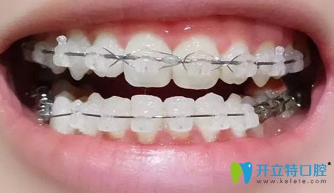 成都拜博口腔戴牙套10個(gè)月效果圖 成都拜博口腔戴牙套10個(gè)月效果圖