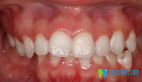 在成都拜博口腔做牙齒正畸前圖片 在成都拜博口腔做牙齒正畸前圖片