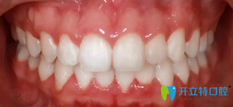 拜博口腔第11個(gè)月去掉牙套后牙齒照片 拜博口腔第11個(gè)月去掉牙套后牙齒照片