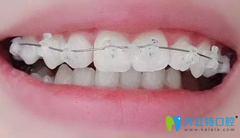 袁本瑤給我做牙齒矯正剛開(kāi)始帶牙套時(shí)候樣子 袁本瑤給我做牙齒矯正剛開(kāi)始帶牙套時(shí)候樣子