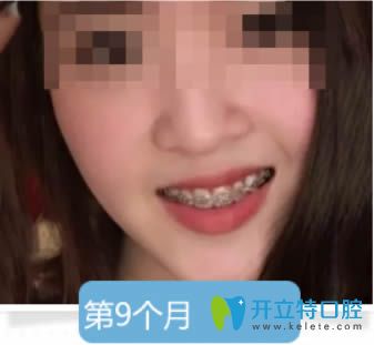 成年人的我佩戴牙套第9個(gè)月的效果 成年人的我佩戴牙套第9個(gè)月的效果