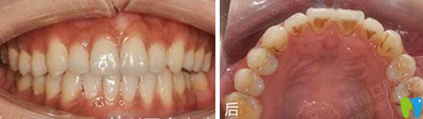 天津拜博口腔隱形矯正18個月后效果