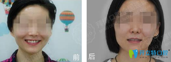 拜博口腔正畸前后效果對比