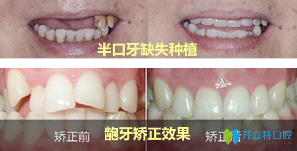 優(yōu)伢仕口腔種植牙+牙齒矯正效果案例