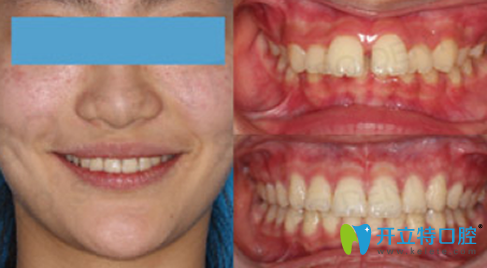 昆明拜博口腔牙齒隱形矯正前后對比圖展示