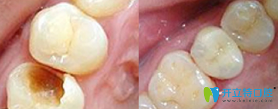 拜博口腔靠譜不？公布我的補(bǔ)牙治療前后對比圖