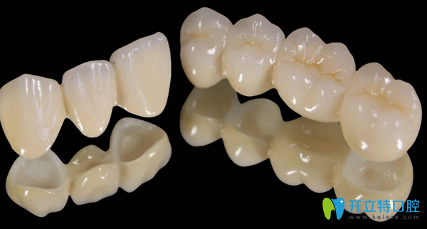 烤瓷牙適合牙齒斷裂修復