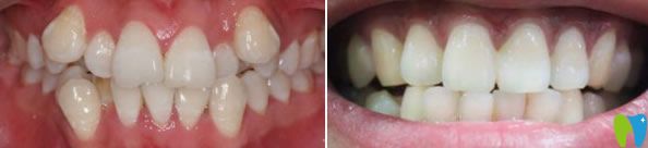 劉赤東院長牙齒正畸案例見證 劉赤東院長牙齒正畸案例見證