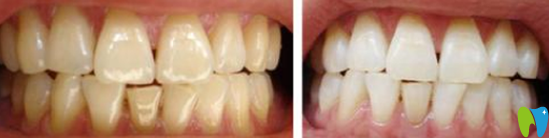 昆明拜博口腔怎么樣？親們可以參考我的潔牙<span style=