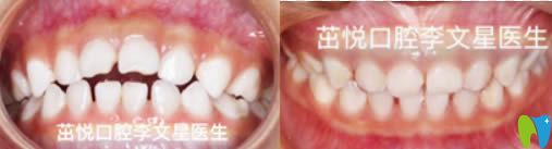 成都茁悅口腔兒童牙齒矯正效果對(duì)比圖