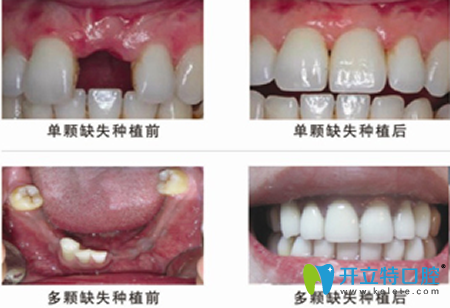 廈門登特口腔牙齒種植前后效果對比圖