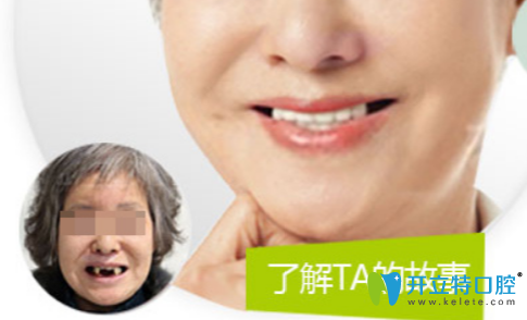 無(wú)錫北極星口腔多顆牙缺失種植案例