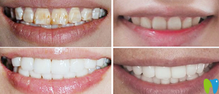 廈門登特口腔林鋆牙齒美白前后效果對比圖 廈門登特口腔林鋆牙齒美白前后效果對比圖
