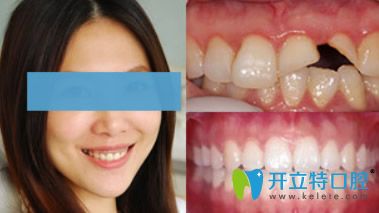 拜博口腔門(mén)牙缺損烤瓷牙修復(fù)案例