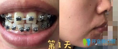熊洪元做牙齒矯正第1天樣子 熊洪元做牙齒矯正第1天樣子