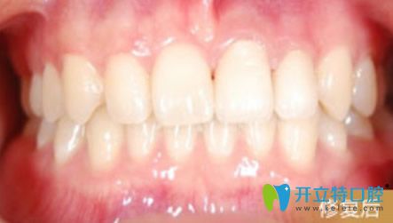 缺損牙齒全瓷牙修復(fù)后的效果 缺損牙齒全瓷牙修復(fù)后的效果