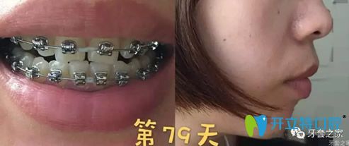 在無錫北極星口腔戴牙套第79天情況 在無錫北極星口腔戴牙套第79天情況