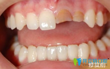 天津陽光樹口腔烤瓷牙修復(fù)牙齒前 天津陽光樹口腔烤瓷牙修復(fù)牙齒前