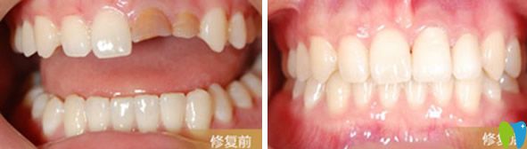陽光樹口腔烤瓷牙修復(fù)前后效果對比 陽光樹口腔烤瓷牙修復(fù)前后效果對比