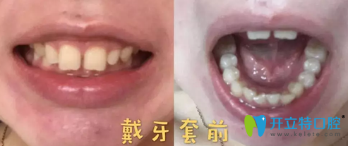 沒有找無錫北極星口腔熊洪元戴牙套之前的照片 沒有找無錫北極星口腔熊洪元戴牙套之前的照片