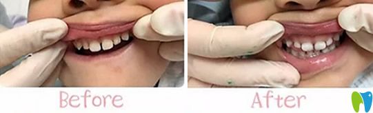 <!--<i data=20240703-sp></i>-->兒童口腔好不好？不妨看看孩子牙齒矯正案例效果
