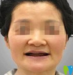 牙友稱(chēng)在寧波牙博士口腔做即刻種植牙價(jià)格實(shí)惠 