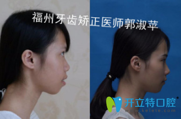 牙醫(yī)郭淑蘋時(shí)代天使隱形矯正案例對(duì)比效果
