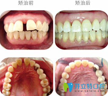 郭淑蘋牙列散在間隙（1-6mm）矯正案例