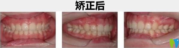 西安瑞泰口腔成年人矯正案例