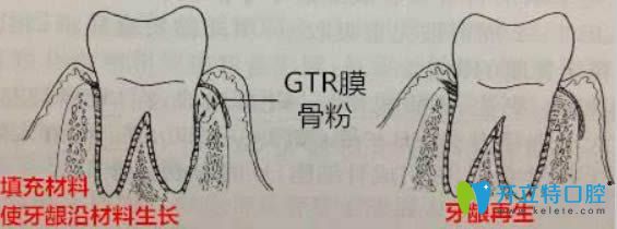 開(kāi)立特牙齦再生術(shù)圖解