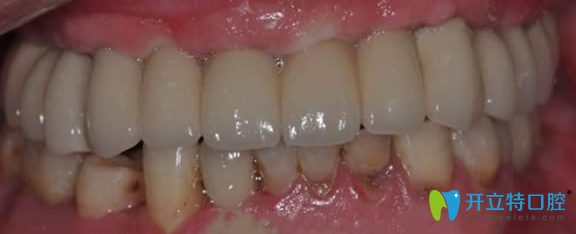 半口牙缺失術(shù)后效果圖