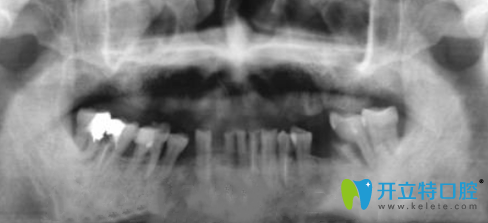 金臺(tái)口腔為張叔拍完X光