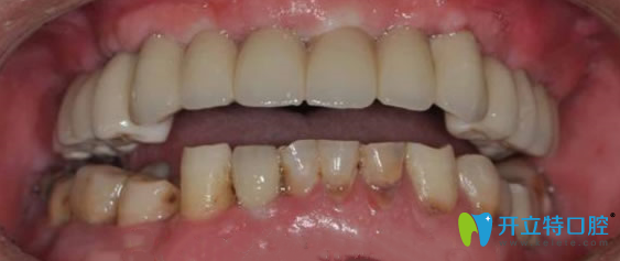 張叔戴上牙冠后