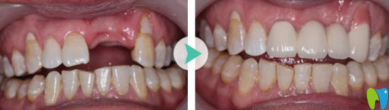 福州維樂口腔張俊偉怎么樣？看牙齒種植案例效果