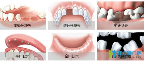 種植牙適應(yīng)的人群 種植牙適應(yīng)的人群