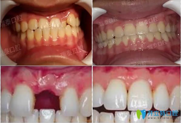 青島瑞泰地包天矯正及門(mén)牙缺失種植前后對(duì)比效果 青島瑞泰地包天矯正及門(mén)牙缺失種植前后對(duì)比效果