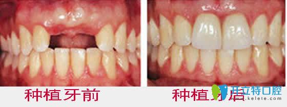 <!--<i data=20240703-sp></i>-->齒科種植牙前后效果對(duì)比圖 <!--<i data=20240703-sp></i>-->齒科種植牙前后效果對(duì)比圖