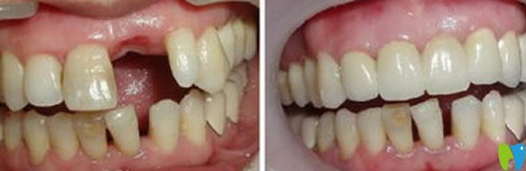 李永平單顆牙即刻種植代表案例 李永平單顆牙即刻種植代表案例