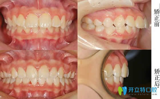 山西眾植齒科牙齒矯正案例效果圖 山西眾植齒科牙齒矯正案例效果圖