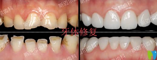 北京斯邁爾齒科楊雷牙齒美學修復效果圖