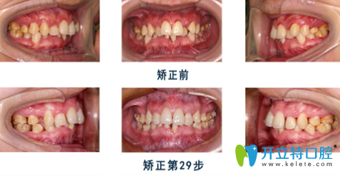 牙醫(yī)許長記怎么樣？看許長記牙齒深覆頜矯正案例