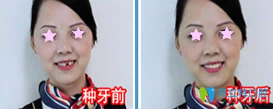 泉州維樂(lè)口腔種植牙案例效果圖