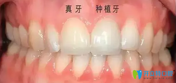 廣州壹加壹口腔門牙缺失種植修復效果