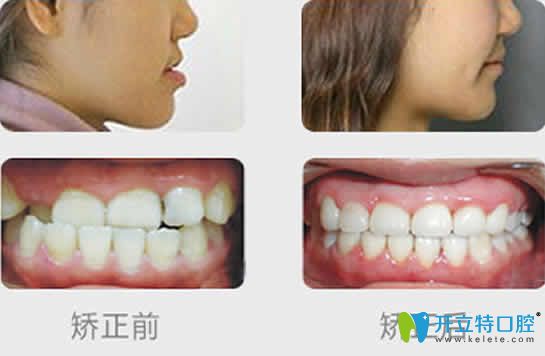 維樂(lè)口腔牙齒矯正前后效果對(duì)比圖