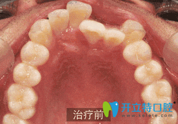 廣州壹加壹口腔矯正牙齒前 廣州壹加壹口腔矯正牙齒前