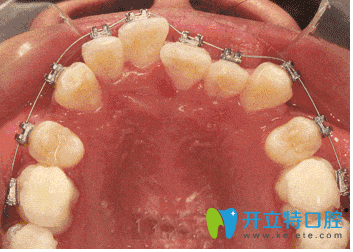 自鎖托槽矯正牙齒進(jìn)行中 自鎖托槽矯正牙齒進(jìn)行中