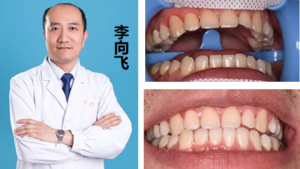 冷光美白牙齒多少錢 李向飛口腔680元的價(jià)格你確定要錯(cuò)過嗎